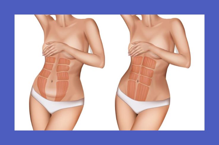 Cómo evitar la diastasis abdominal en el embarazo